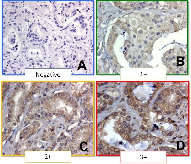 IHC staining to assess PTP1B expression in prostate cancer tissue samples.
